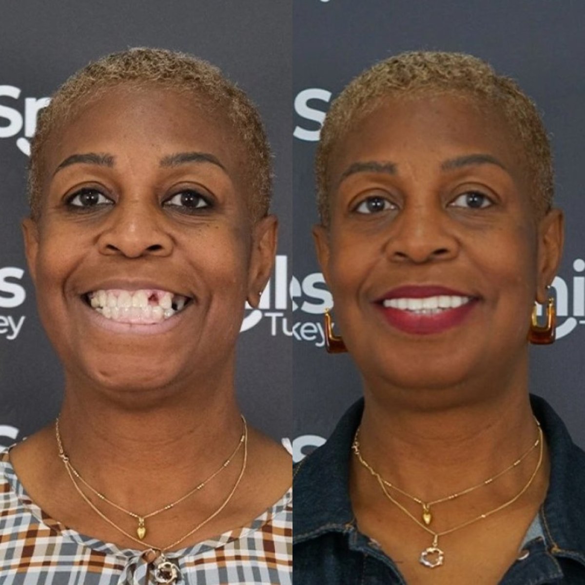 Before and after smile makeover at SmilesTurkey – dental restoration and improved smile result