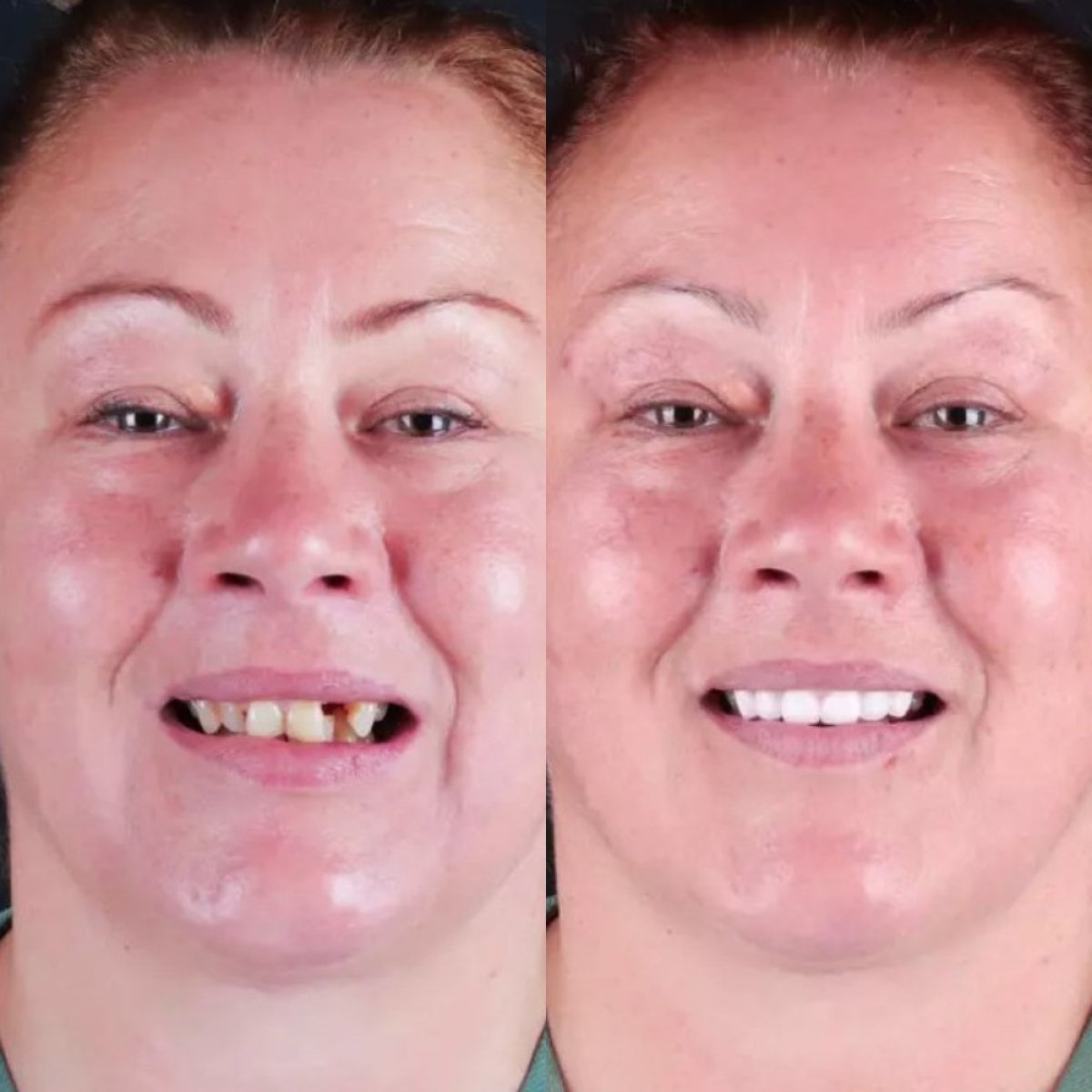 Результаты до и после улыбки в SmilesTurkey – полное восстановление зубов