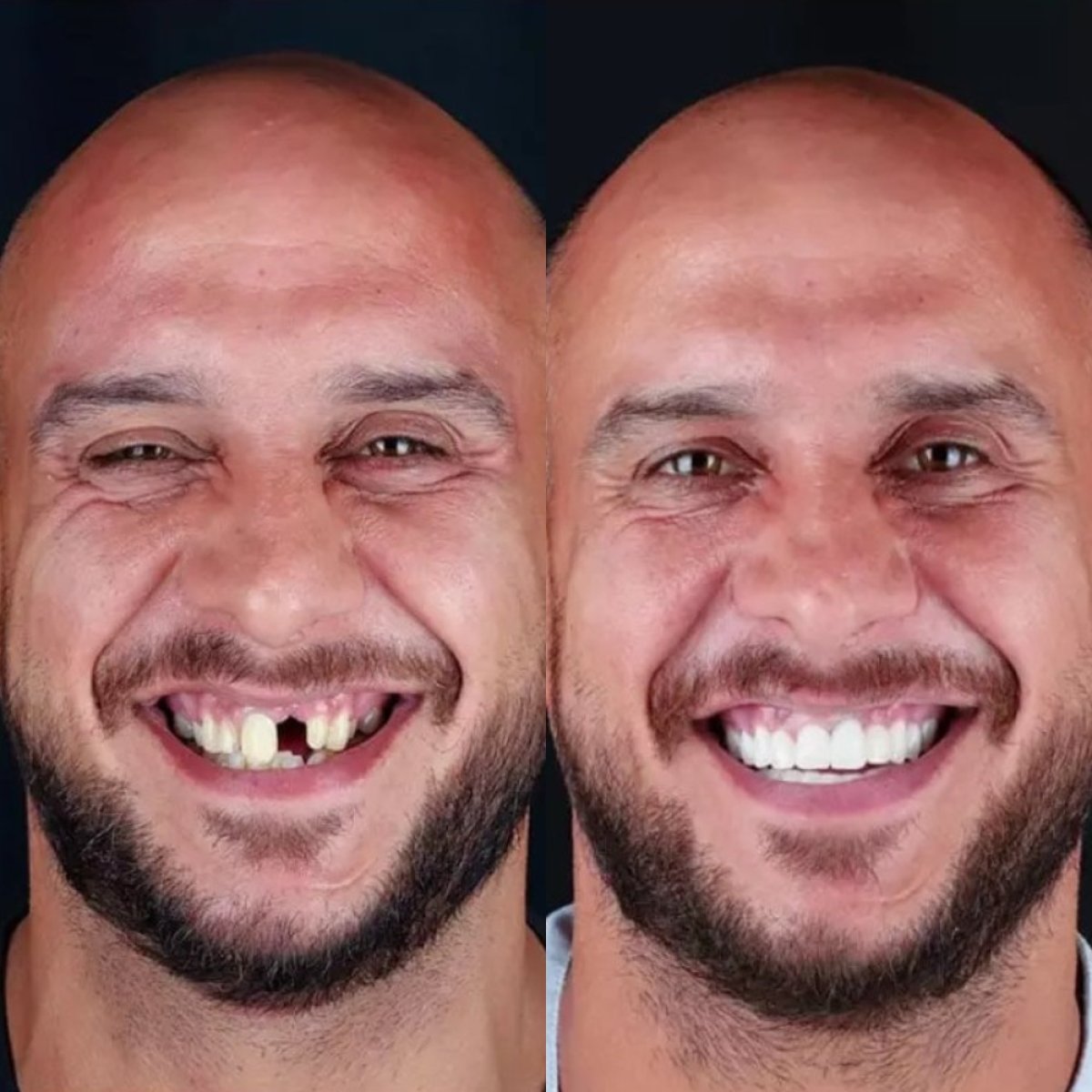 Before and after smile makeover at SmilesTurkey – dental restoration and whiter teeth result