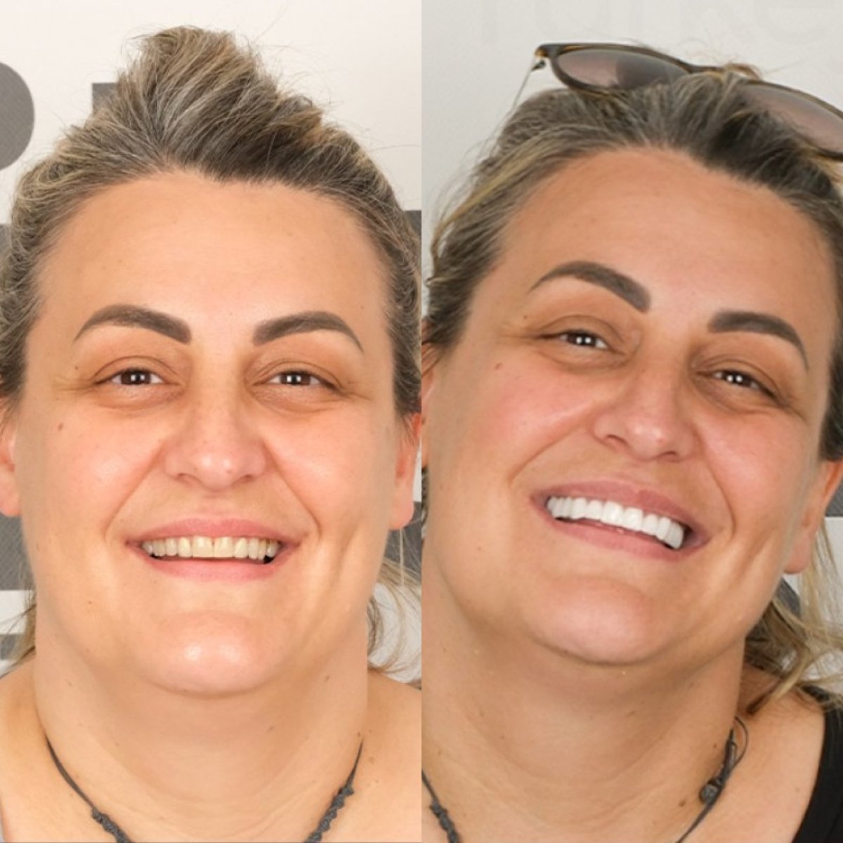 Результаты лазерного отбеливания зубов до и после в SmilesTurkey – более яркая улыбка
