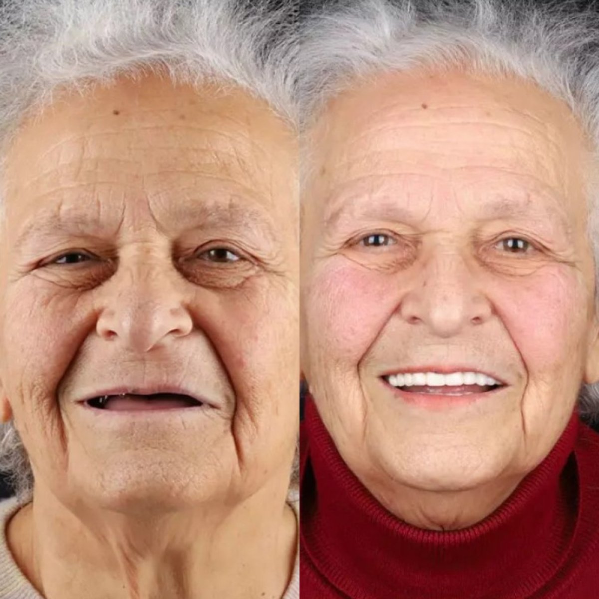 Before and after dental prosthetics installation at SmilesTurkey – restored smile result