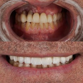 All-on-6 Dental Implants with Crowns & Temporary Prosthesis — 4-Star Hotel, 9 Nights - photo 4
