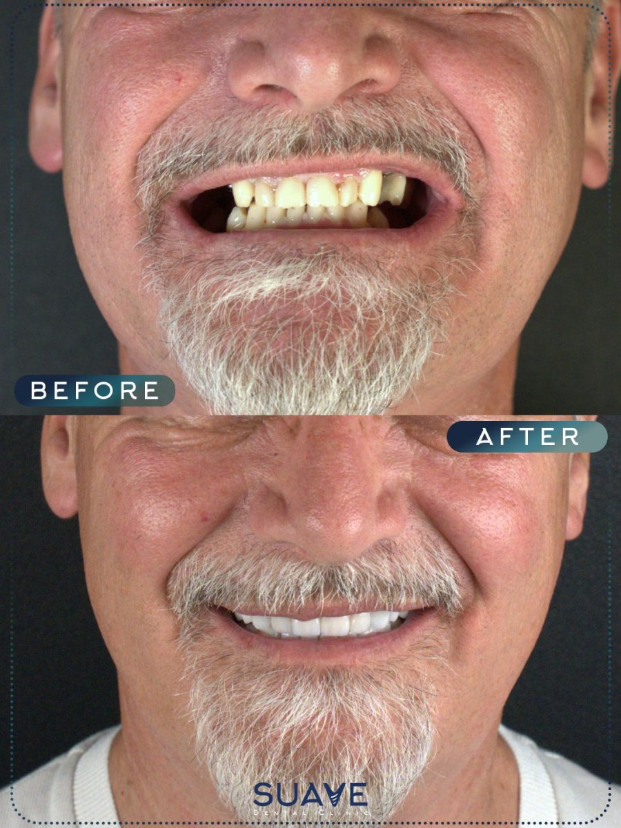 Before and after Emax veneers at SUAVE DENTAL CLINIC, smile makeover result for missing teeth