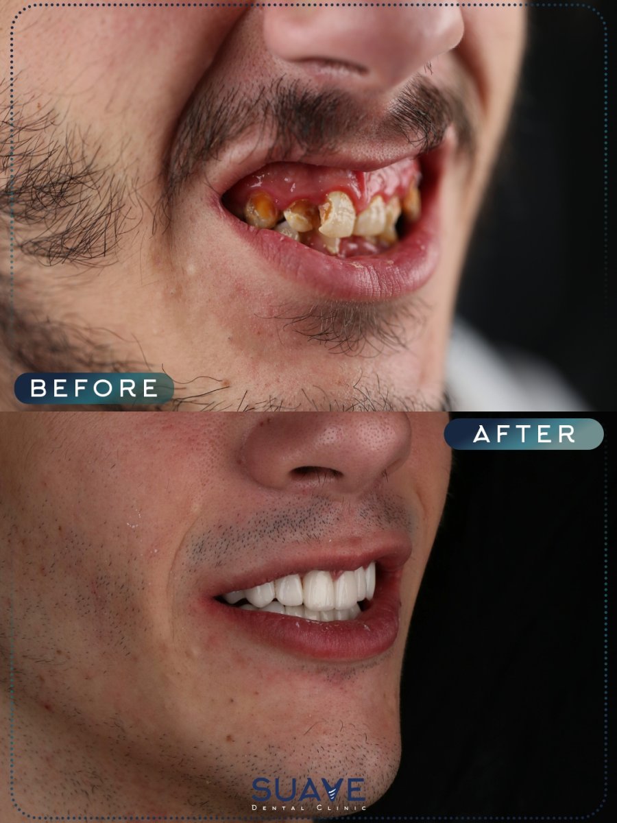 Efekt przed i po licówkach w SUAVE DENTAL CLINIC – naturalna metamorfoza uśmiechu