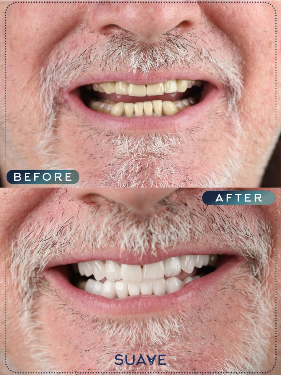 Efekt przed i po licówkach w SUAVE DENTAL CLINIC, naturalnie białe zęby