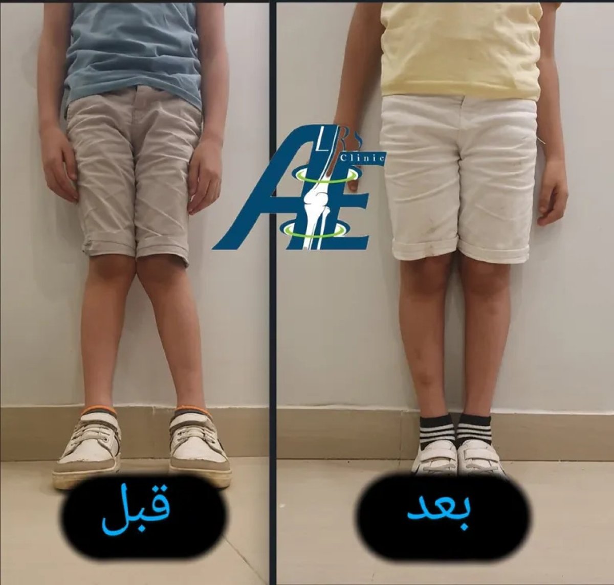 Before and after bone deformity correction surgery results at AE Clinic, improved leg alignment