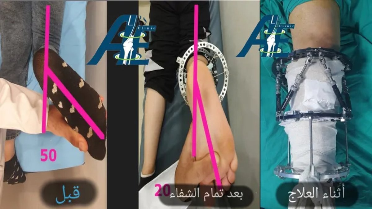Before and after bone deformity correction surgery results at AE Clinic, improved leg alignment