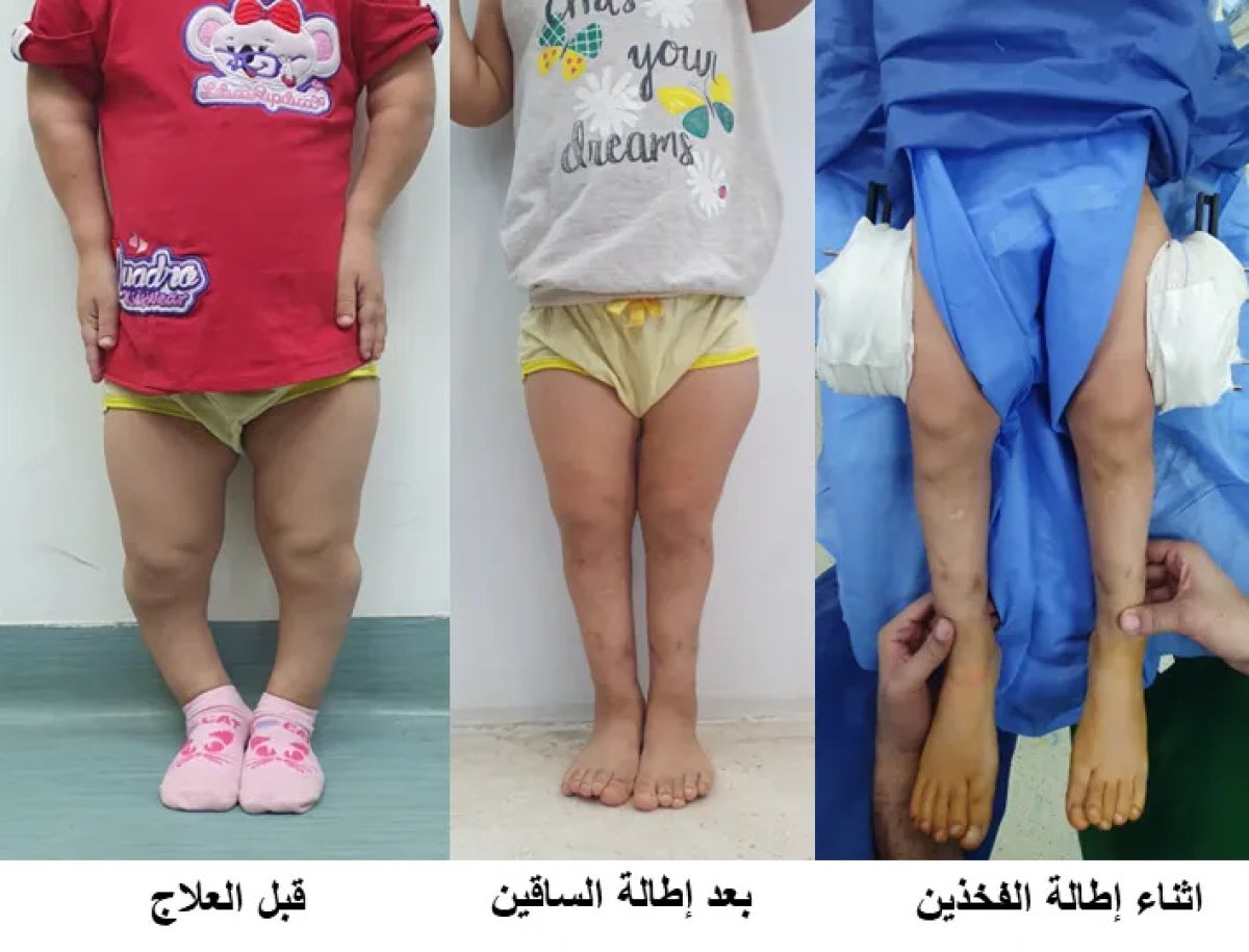 Before and after limb lengthening surgery results in child, visible leg alignment improvement