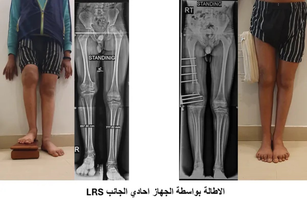 Before and after limb lengthening surgery results with LRS device, improved leg alignment