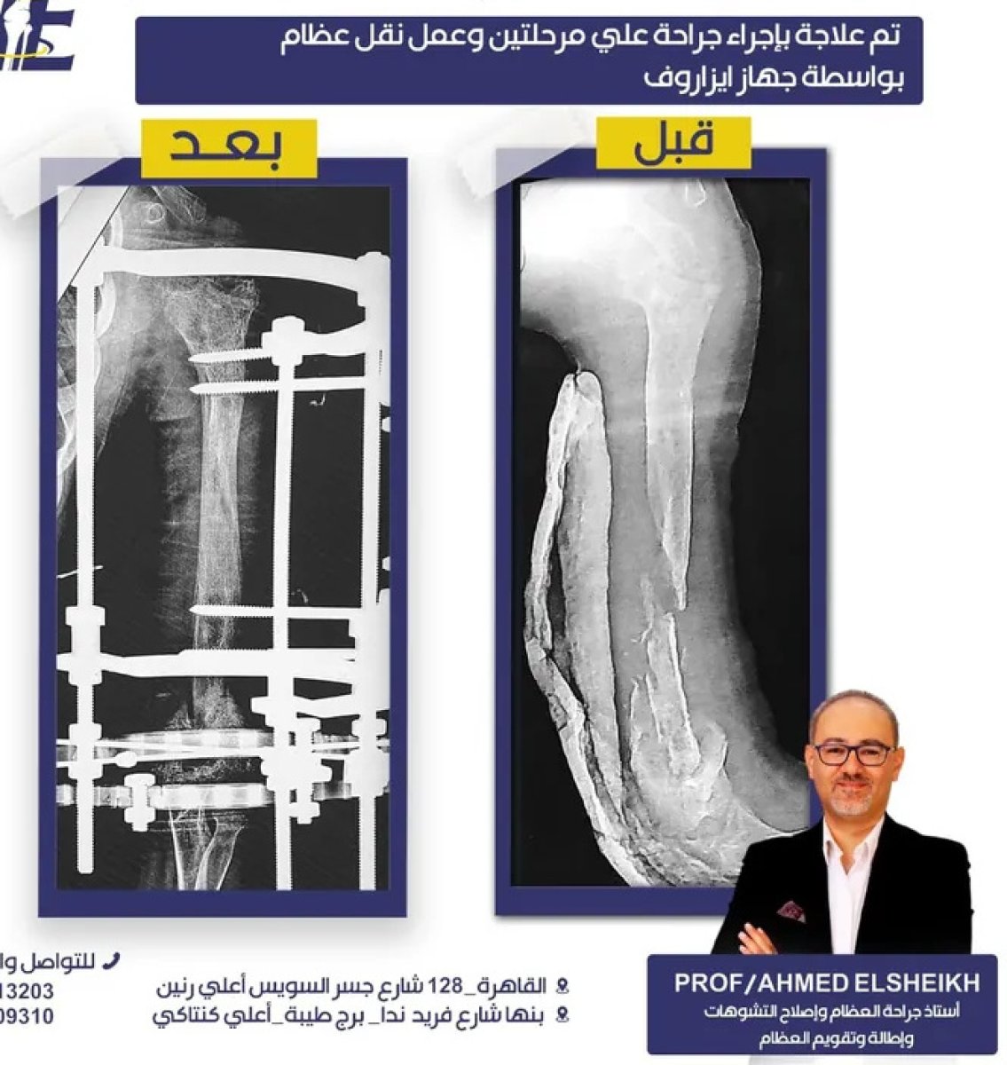 Before and after bone transport surgery with Ilizarov device, limb reconstruction result