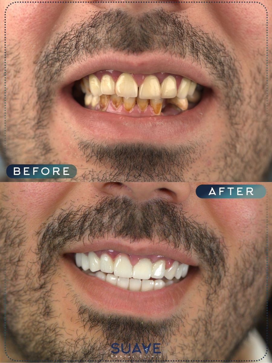 Результаты до и после установки зубных коронок в SUAVE DENTAL CLINIC, восстановление улыбки