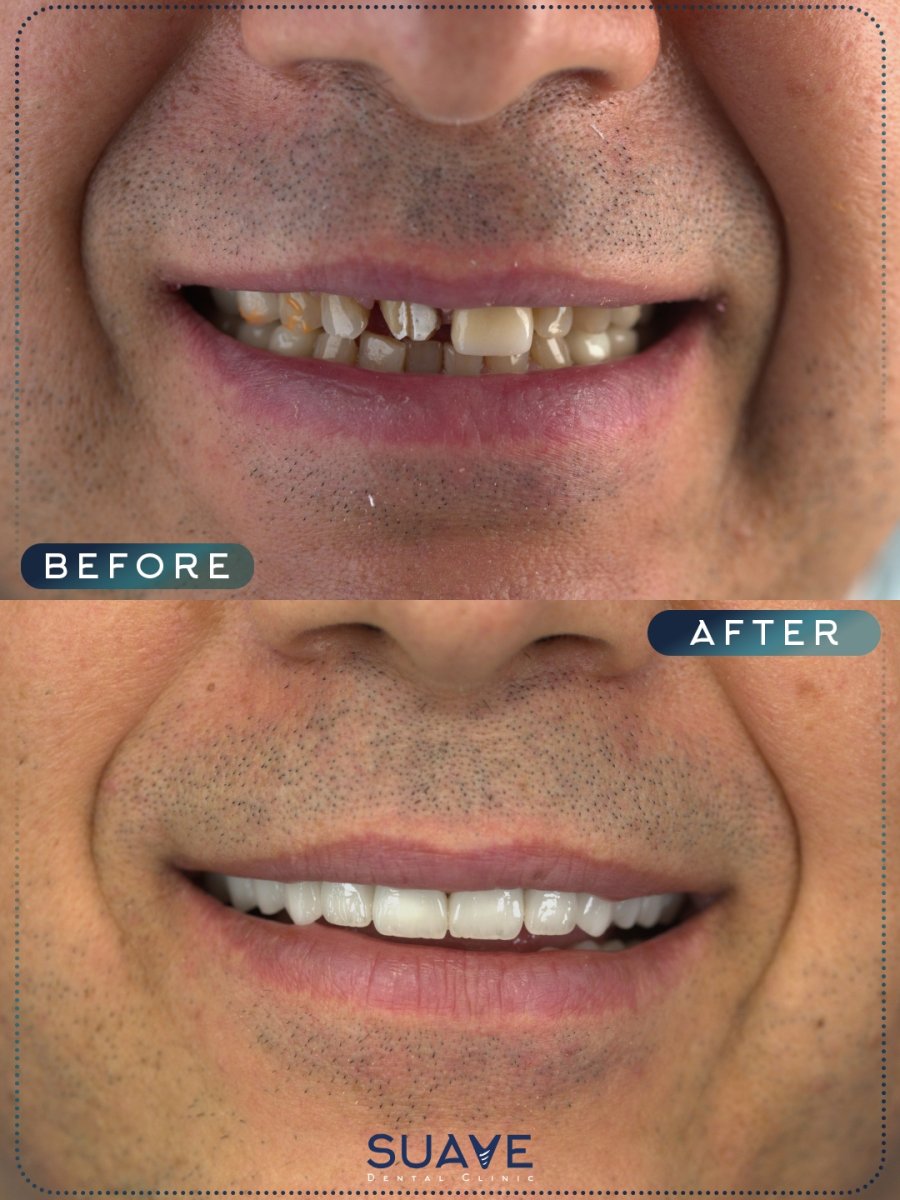 До и после установки зубных коронок в SUAVE DENTAL CLINIC, результат восстановления улыбки