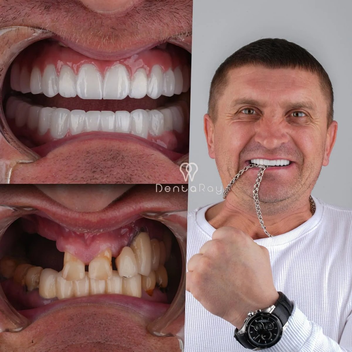 Vorher-nachher-Ergebnis Zahnimplantate bei DentaRay Clinic mit erneuertem Lächeln