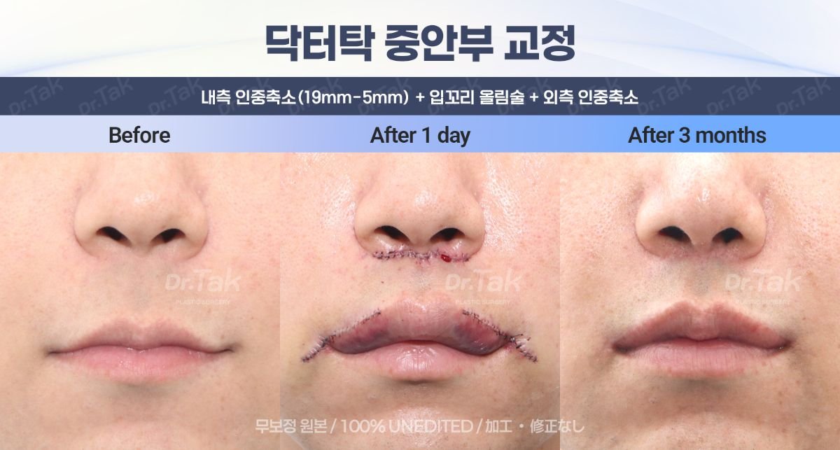Before and after lip lift and philtrum reduction results at Dr. Tak Plastic Surgery clinic
