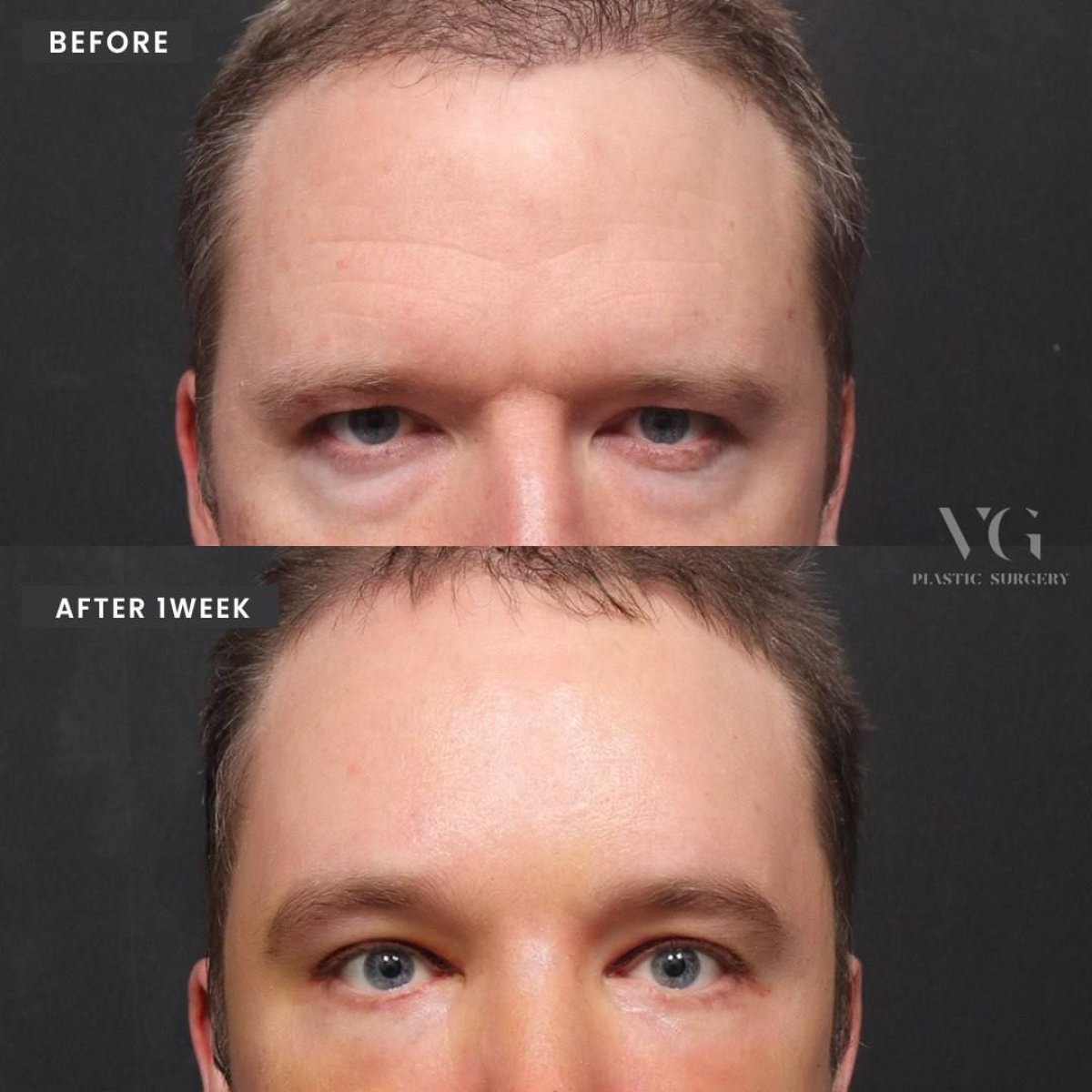نتائج شد الجفن العلوي قبل وبعد في VG Plastic Surgery، مظهر عين محسّن