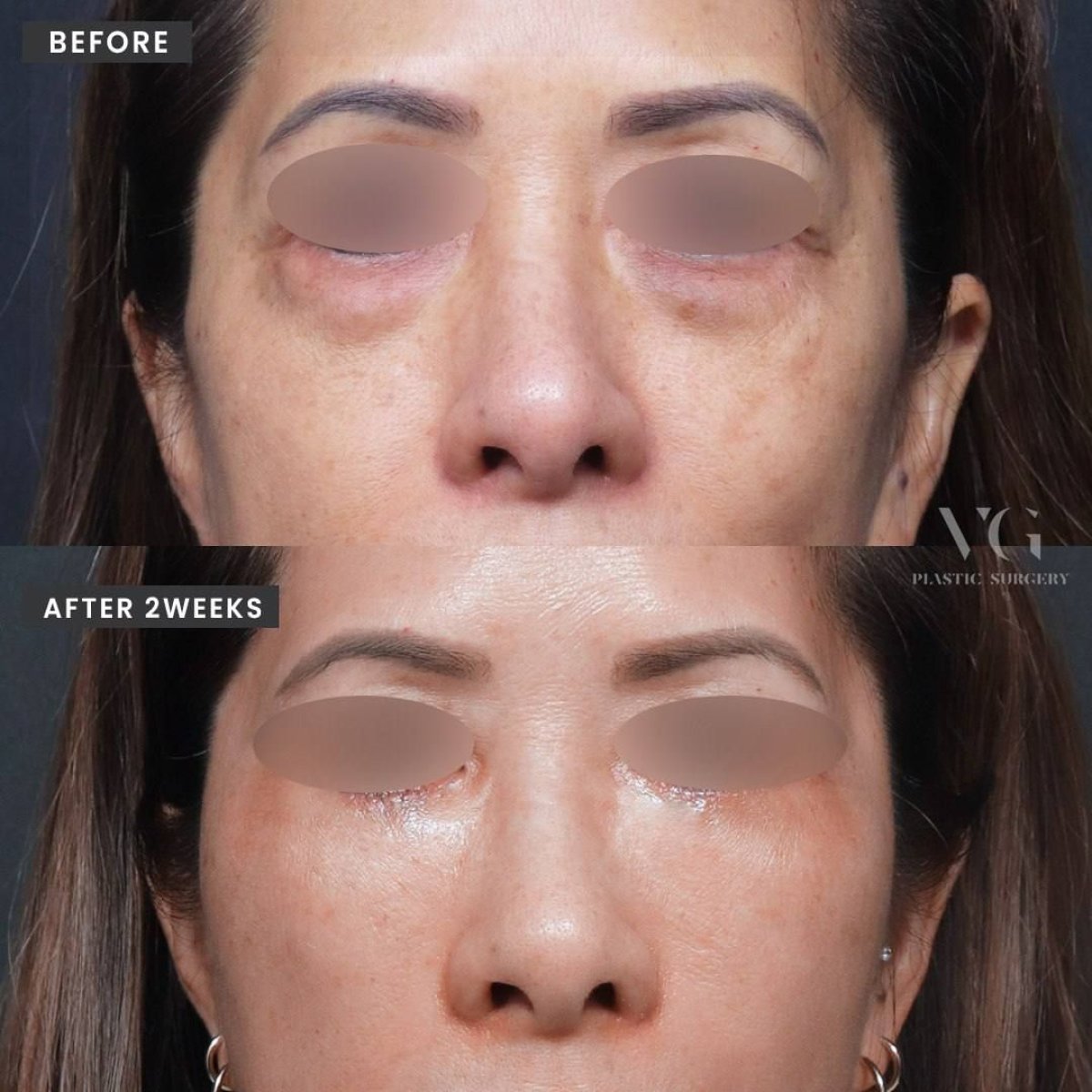 Before and after upper eyelid surgery results at VG Plastic Surgery, improved eye appearance