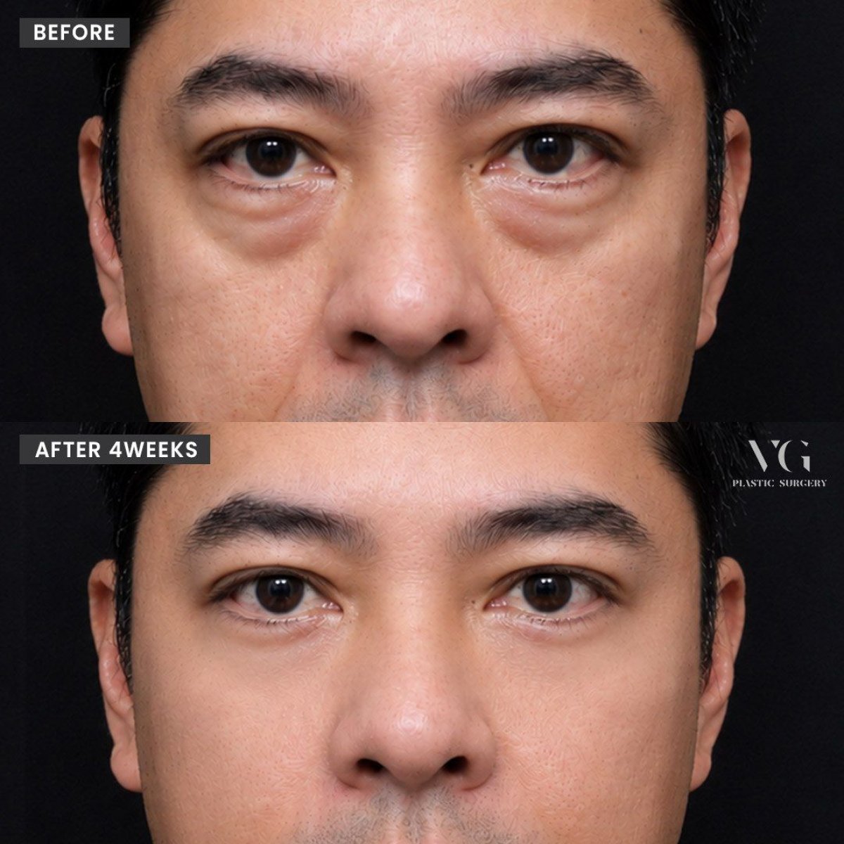Upper eyelid surgery before and after results at VG Plastic Surgery, improved eye appearance