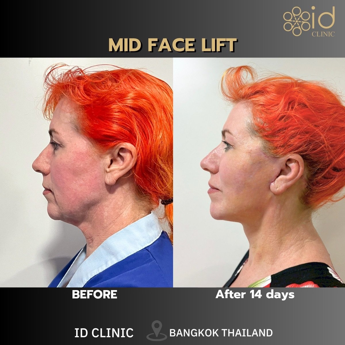 Before and after mid face lift results at ID Clinic Bangkok, visible facial rejuvenation