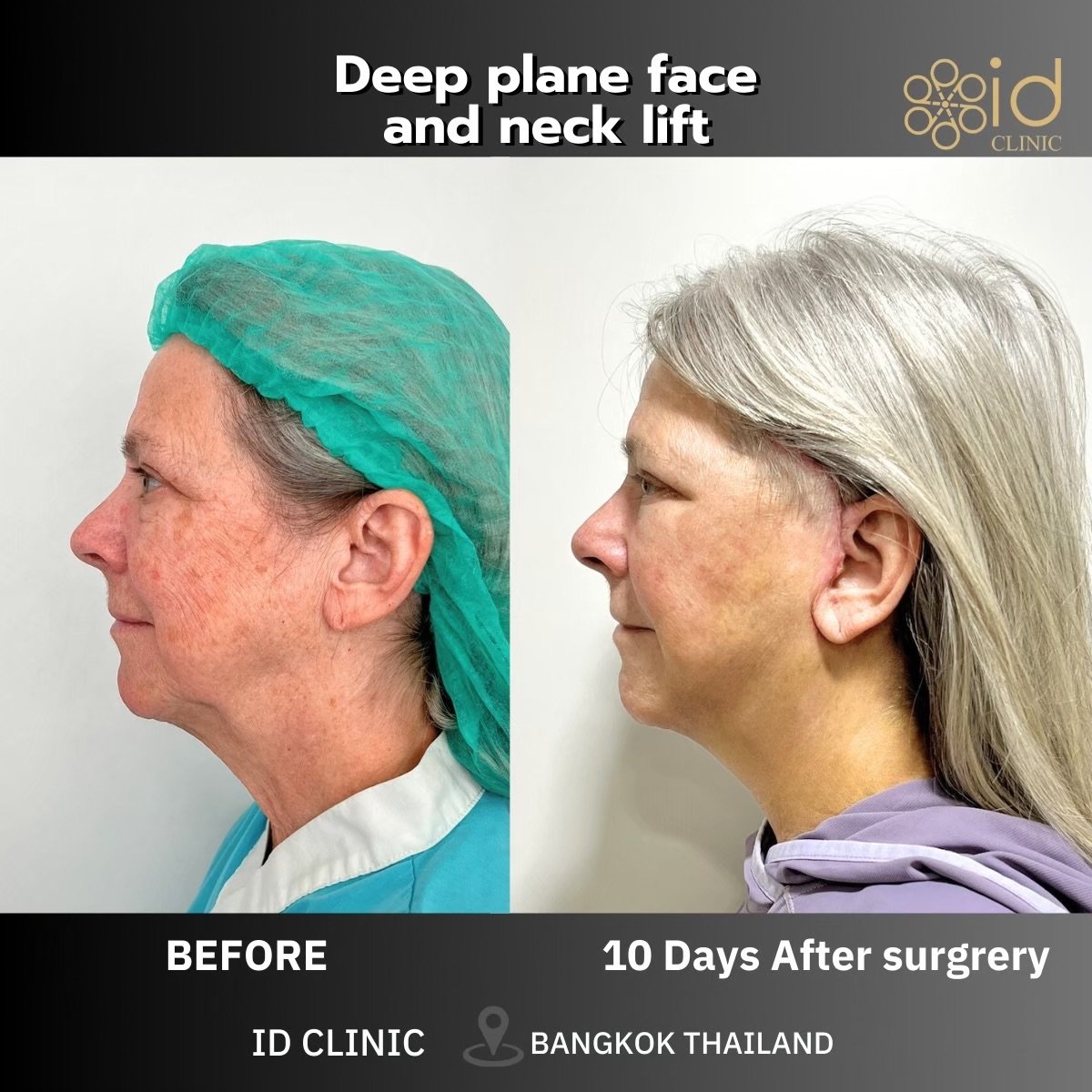 Before and after deep plane face and neck lift results at ID Clinic Bangkok, visible rejuvenation
