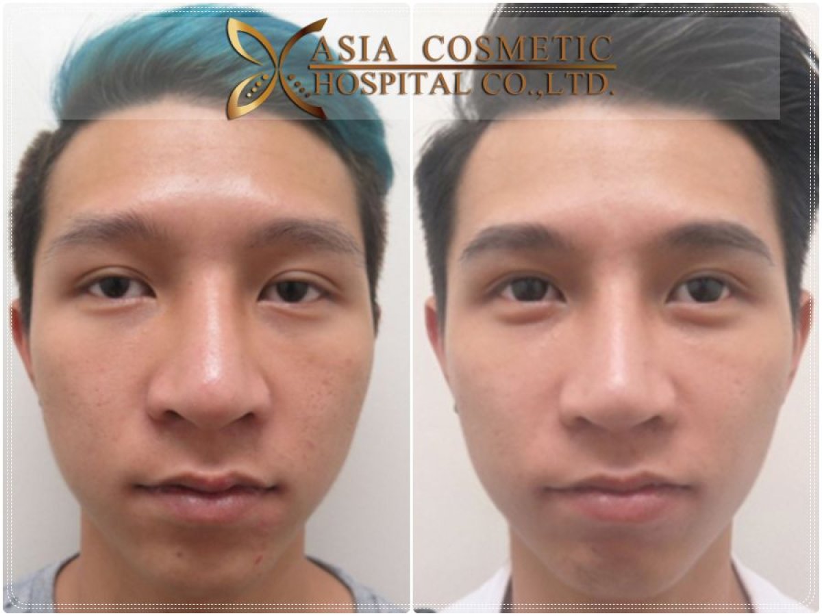 Resultados antes y después de implante de mentón en Asia Cosmetic Hospital, contorno mejorado