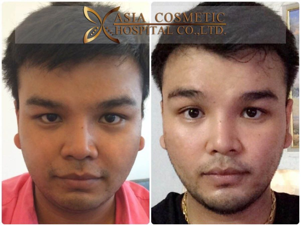 نتائج قبل وبعد زراعة الذقن في Asia Cosmetic Hospital، إبراز شكل الذقن