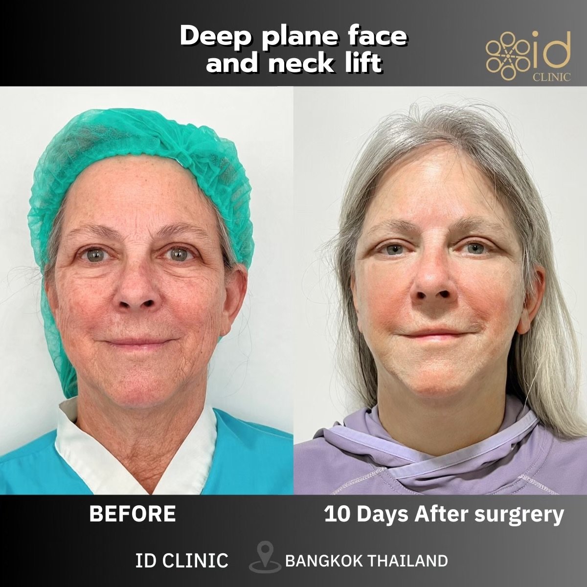 Before and after deep plane face and neck lift results at ID Clinic Bangkok, visible rejuvenation