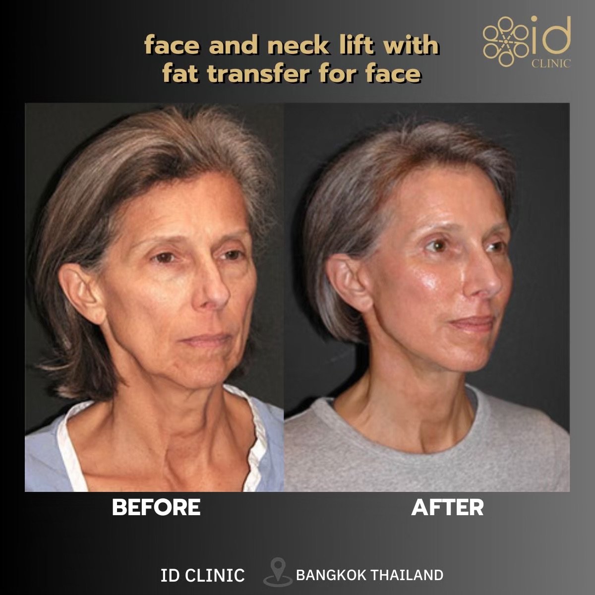 Before and after mini facelift with fat transfer at ID Clinic Bangkok, face and neck lift result