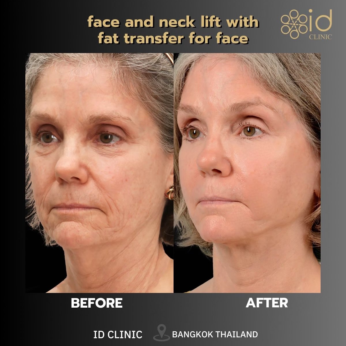 Before and after mini facelift with fat transfer at ID Clinic Bangkok, face and neck lift result