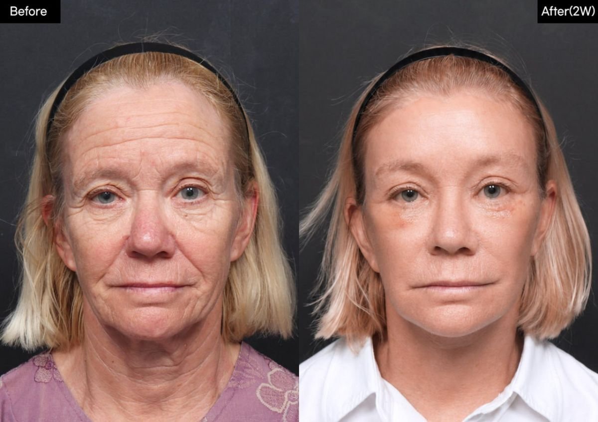 Résultats avant/après lifting deep plane chez VG Plastic Surgery, rajeunissement du visage