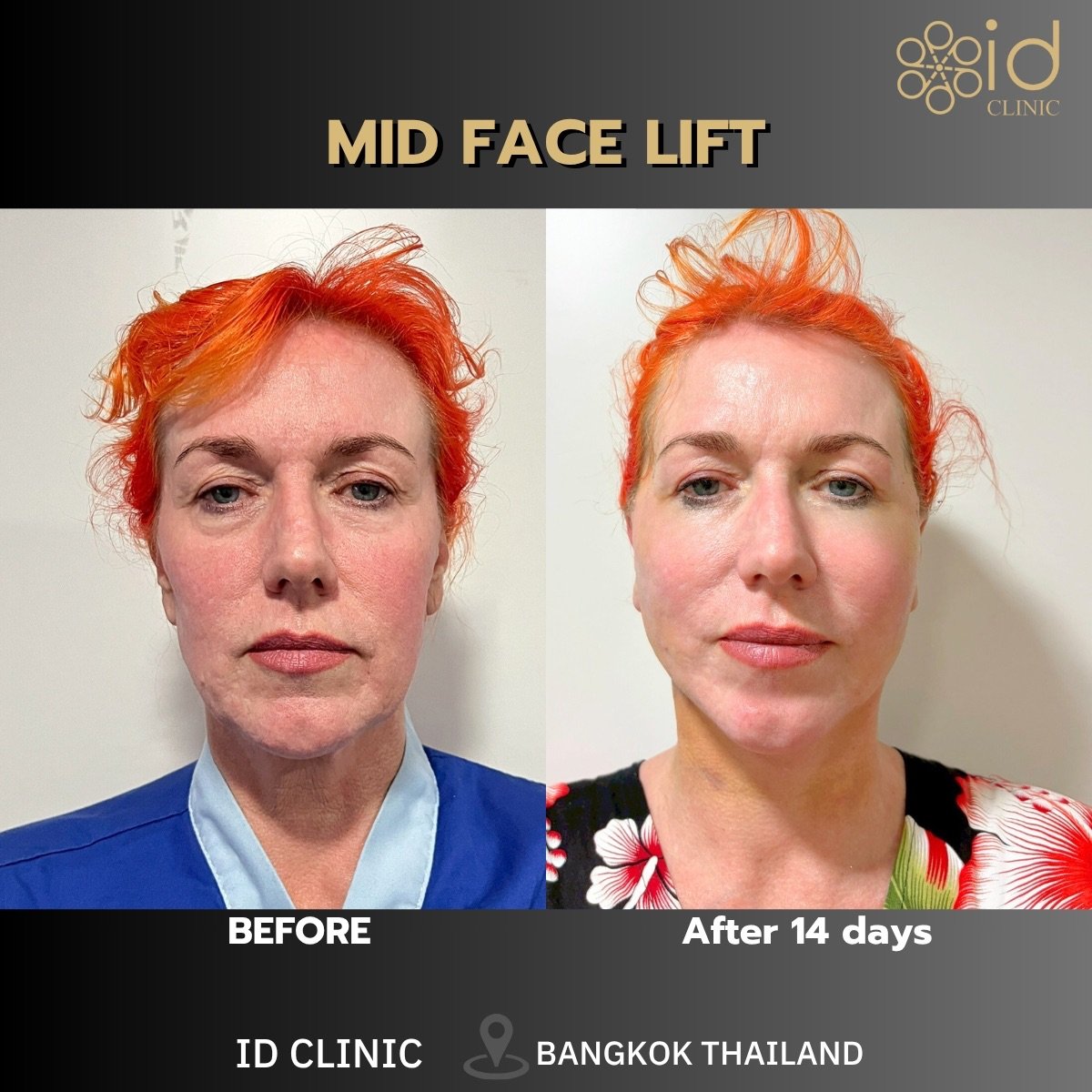 Before and after mid face lift results at ID Clinic Bangkok, visible facial rejuvenation