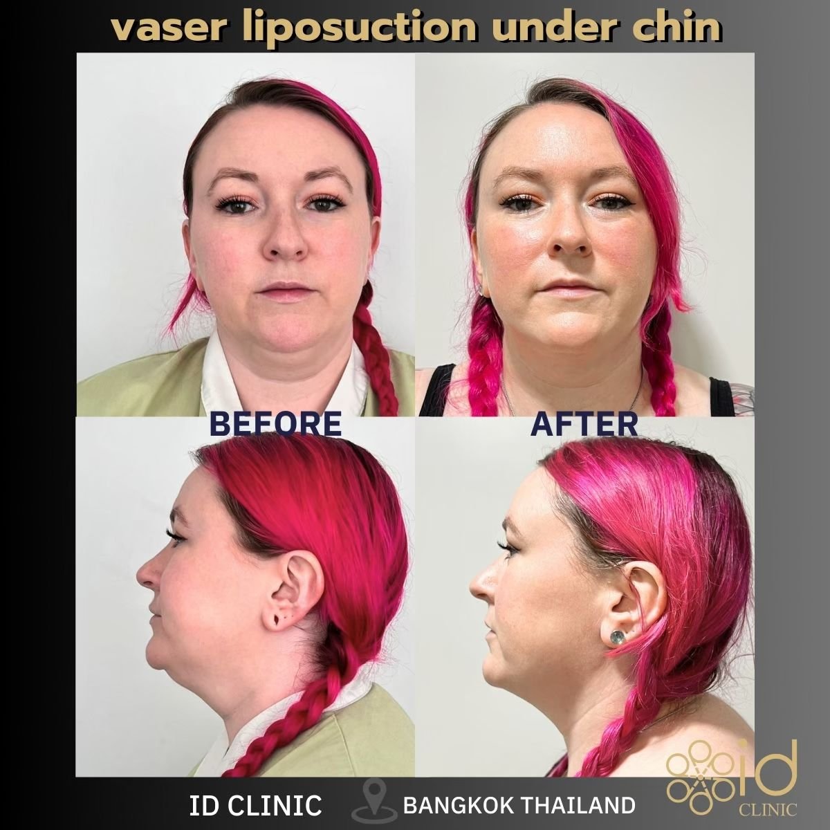 Before and after VASER liposuction under chin at ID Clinic Bangkok, visible contour result