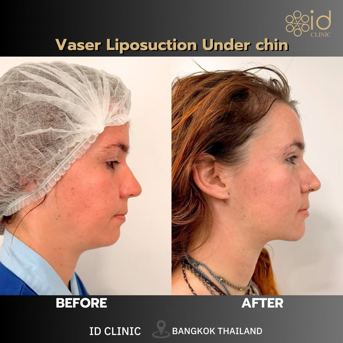 Before and after Vaser liposuction under chin at ID Clinic Bangkok, visible contour result
