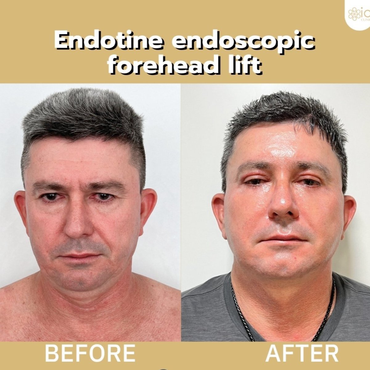 Before and after endotine endoscopic forehead lift results at ID Clinic Bangkok