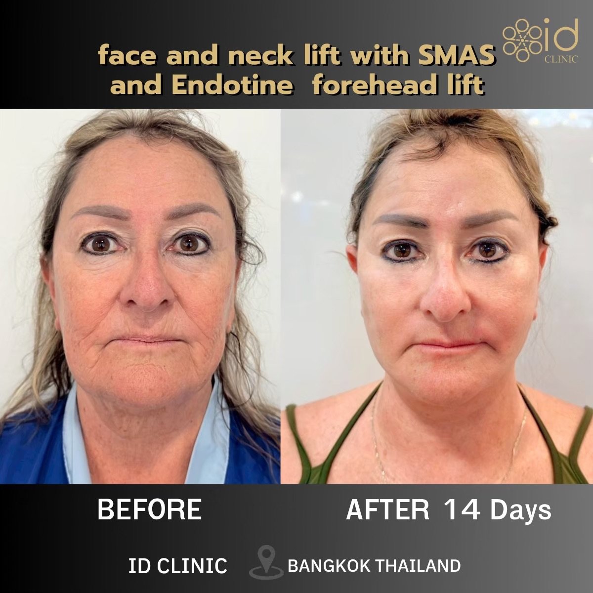 Before and after face and neck lift with SMAS and Endotine brow lift at ID Clinic Bangkok