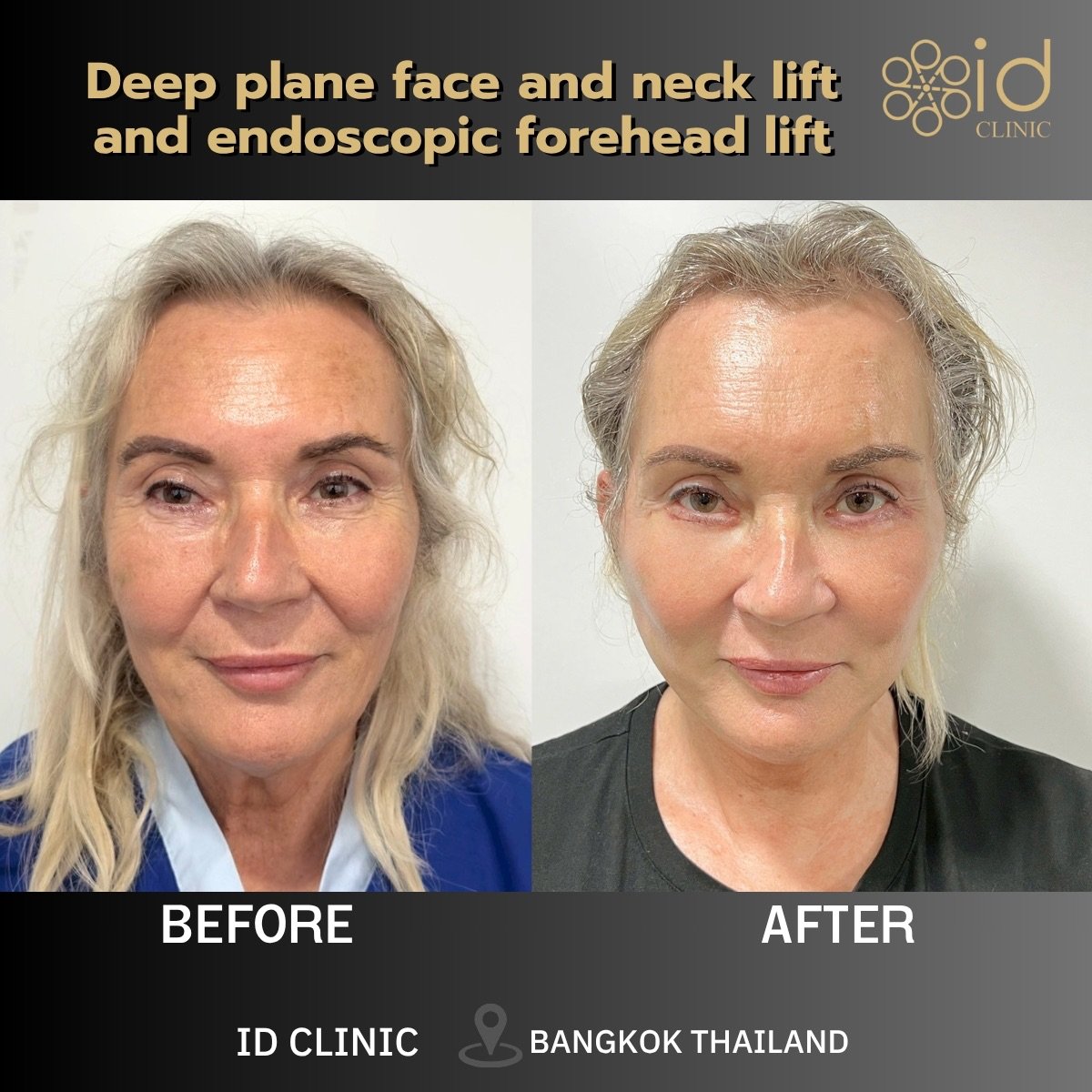 Before and after deep plane face, neck, and forehead lift results at ID Clinic Bangkok
