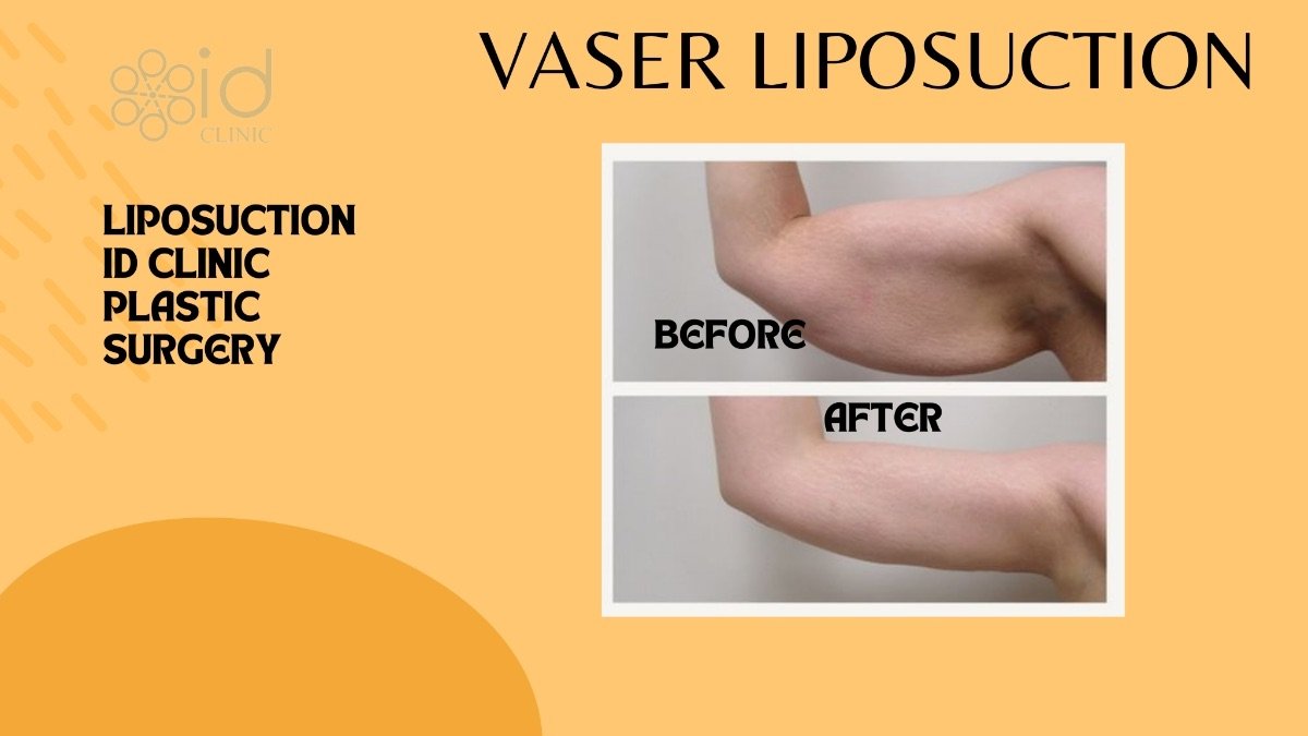Before and after VASER liposuction arm contouring results at ID Clinic Bangkok