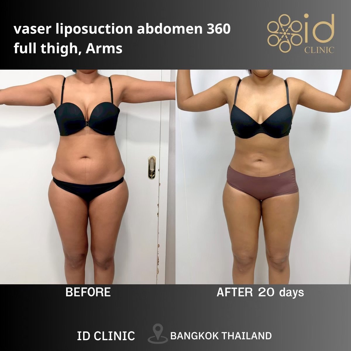 Результаты до и после Vaser липосакции 360 живота, бедер, рук в ID Clinic Bangkok