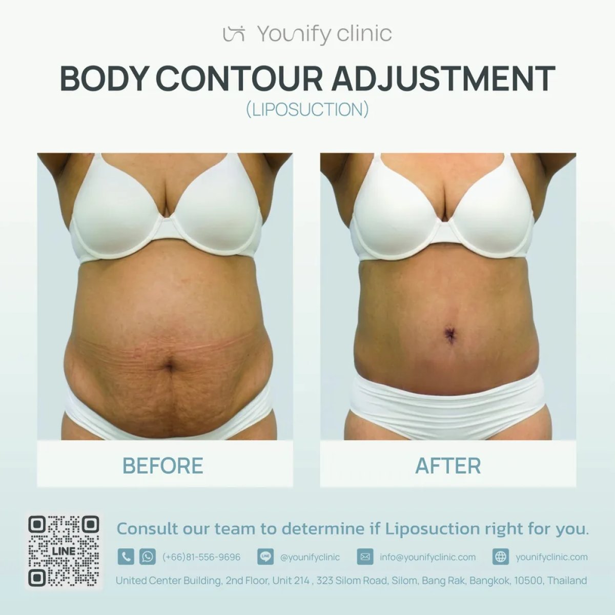 Before and after liposuction results at Younify Clinic – visible abdominal contour improvement