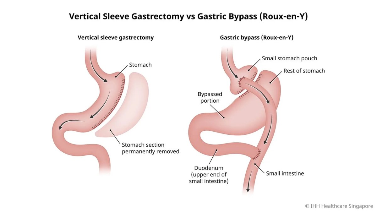 Comparison of gastric sleeve vs gastric bypass surgery, stomach anatomy and procedure results