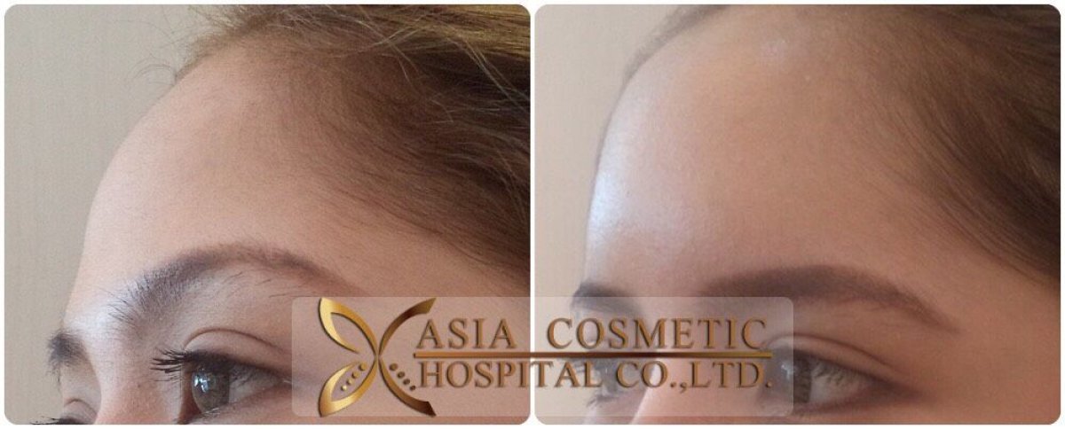 نتائج تكبير الجبهة بالزرع قبل وبعد في Asia Cosmetic Hospital، مظهر جبين أكثر نعومة