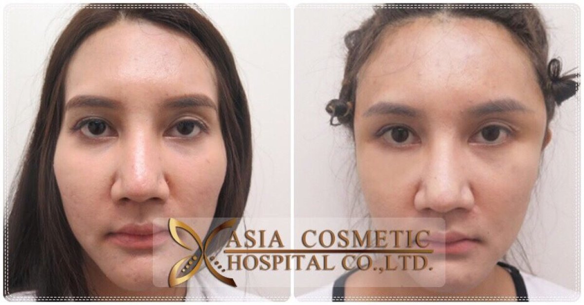 نتائج تكبير الجبهة بالزرع قبل وبعد في Asia Cosmetic Hospital، تحسين شكل الجبهة