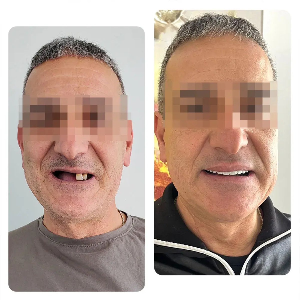 Before and after dental implant results – restored smile and teeth replacement