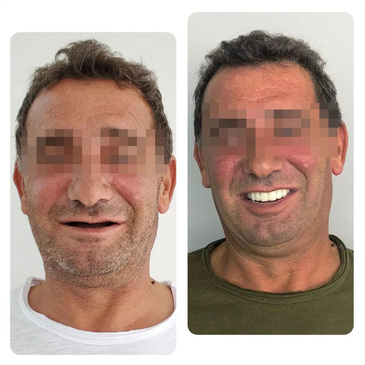 Resultados antes y después de implantes dentales: sonrisa restaurada y transformación dental