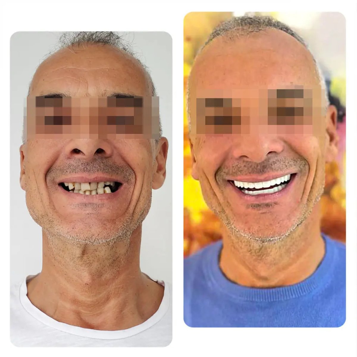 Before and after dental implant results – restored smile and full teeth transformation