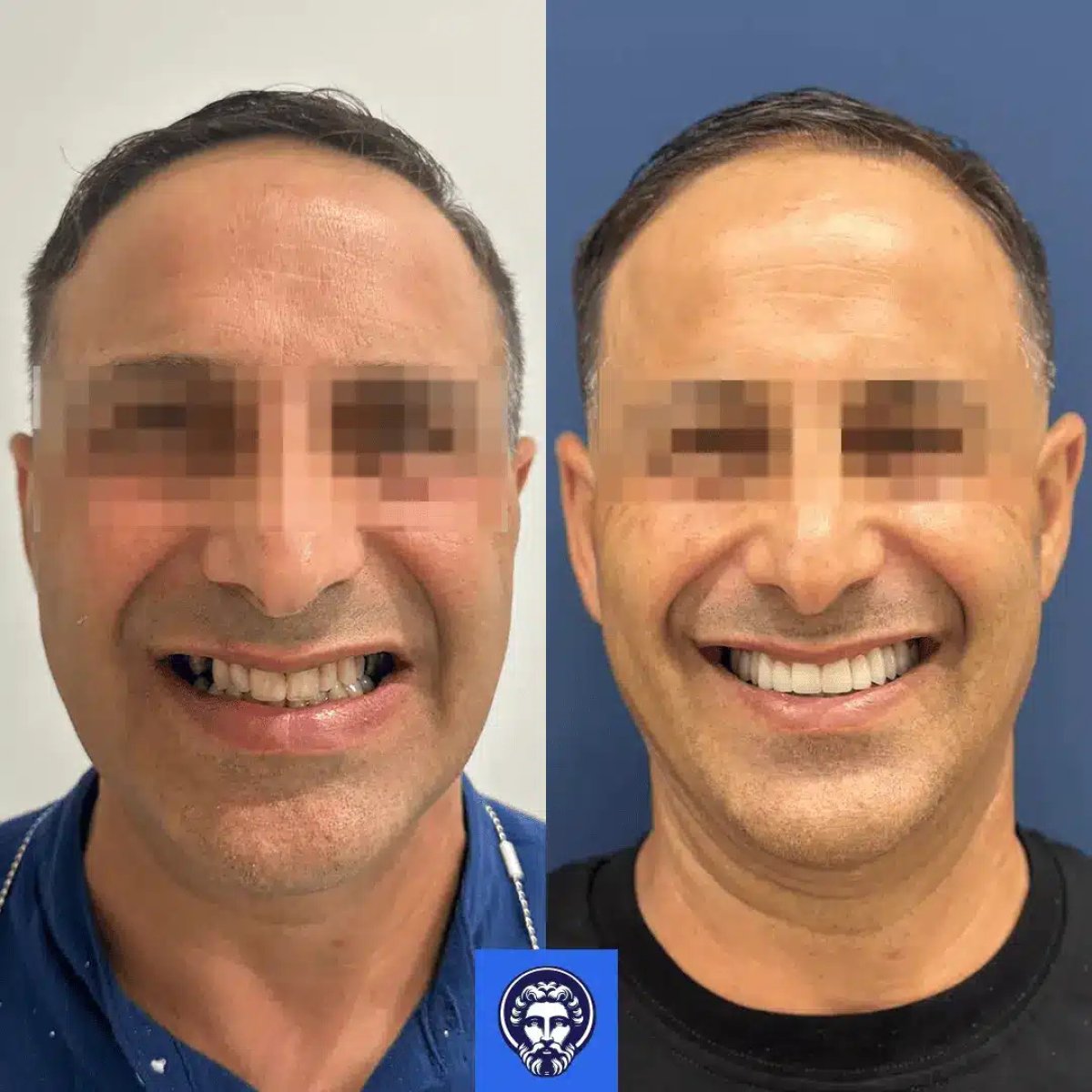 Resultado antes y después de carillas dentales en la clínica: sonrisa mejorada y dientes más blancos