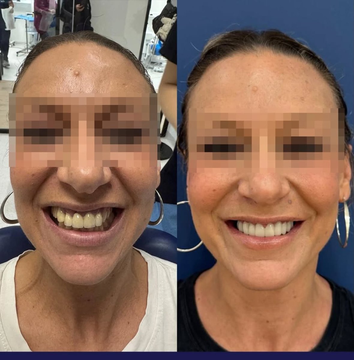 Before and after veneers results – improved smile aesthetics and whiter teeth transformation