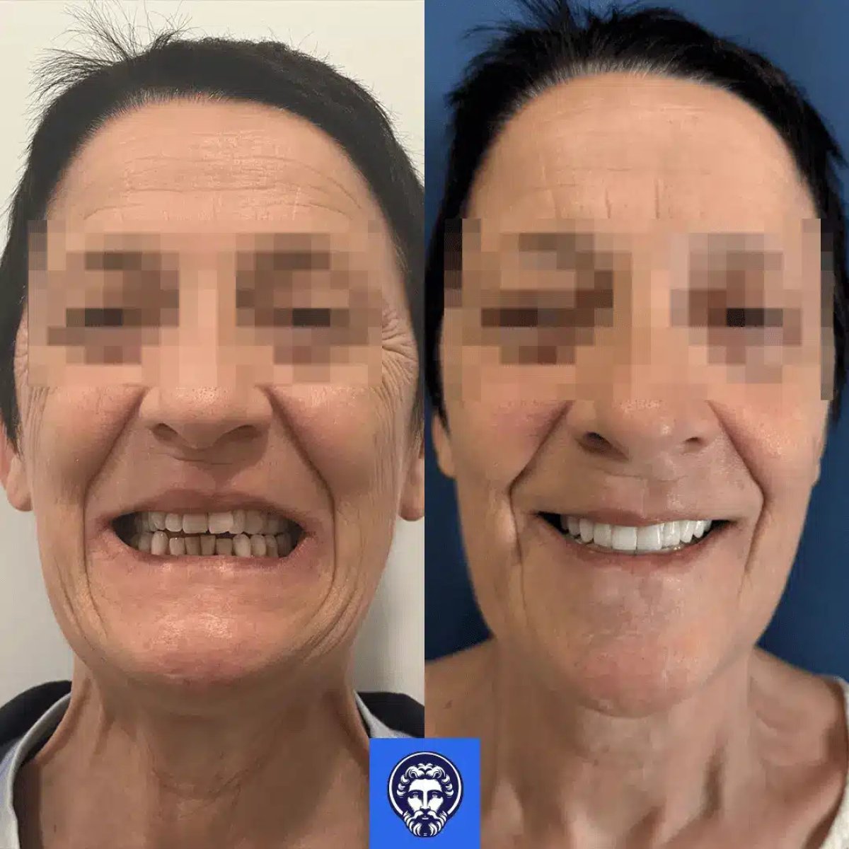 Resultados antes y después de la instalación de prótesis dentales: sonrisa mejorada