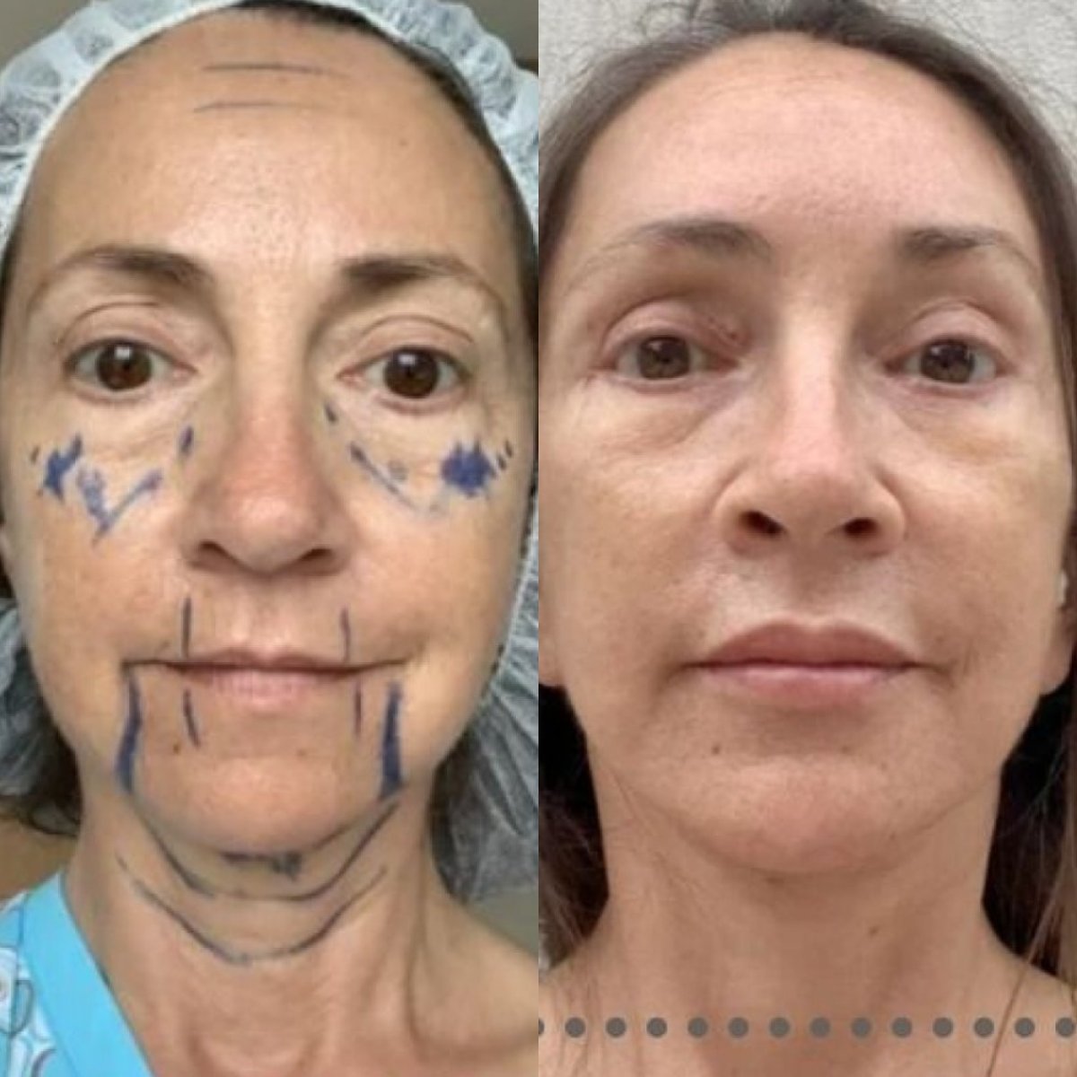 Before and after blepharoplasty results at Memorial Şişli Hospital, eyelid correction procedure