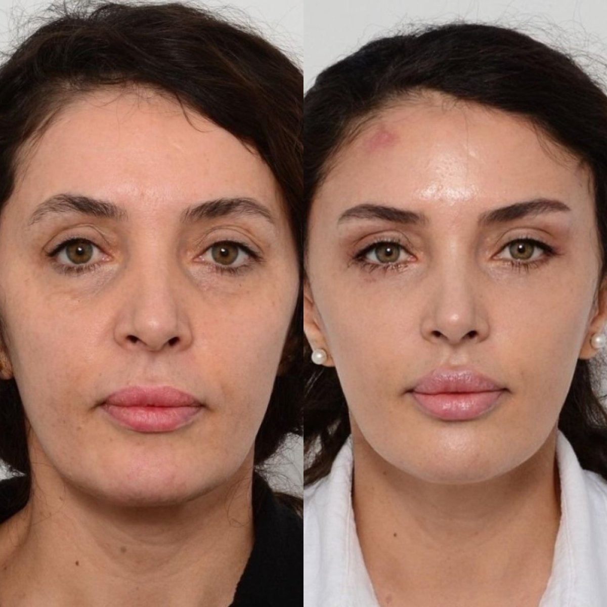 Résultats avant et après blépharoplastie à Memorial Şişli Hospital, correction des paupières