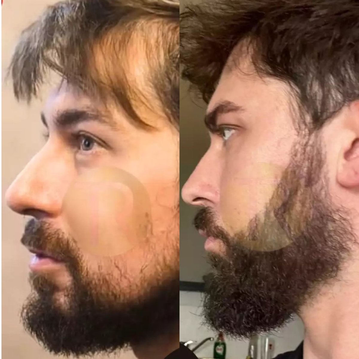 Результати до і після трансплантації вусів у Transes Hair Transplant Center, густе волосся